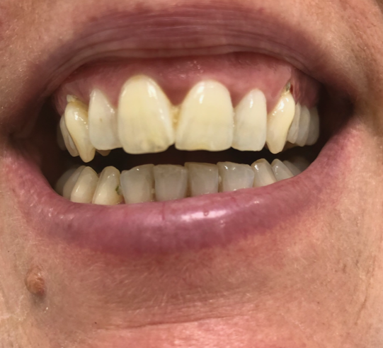 Clear Aligners for Teeth Straightening