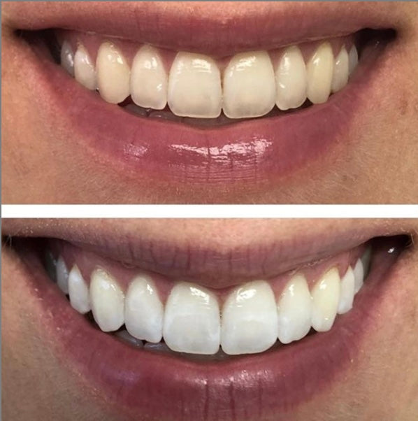 Custom Made Whitening Trays and POLA Whitening Gel