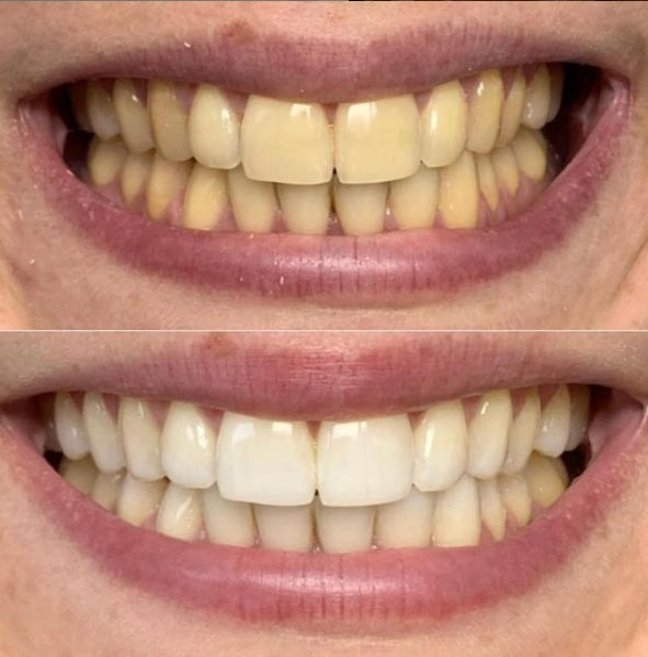 POLA Whitening Gel for Aligners/Retainers