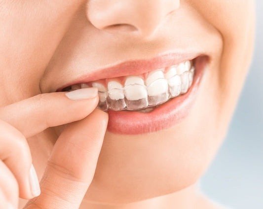 Clear Aligners for Teeth Straightening