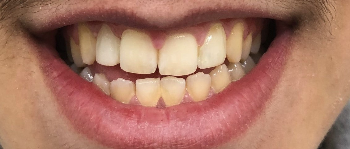 Clear Aligners for Teeth Straightening