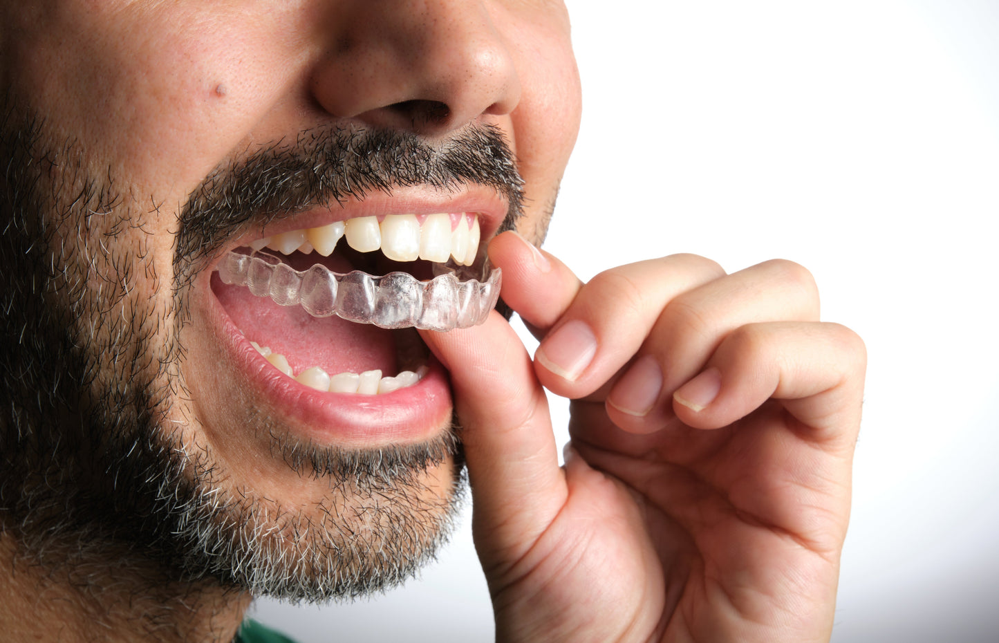 Clear Aligners for Teeth Straightening