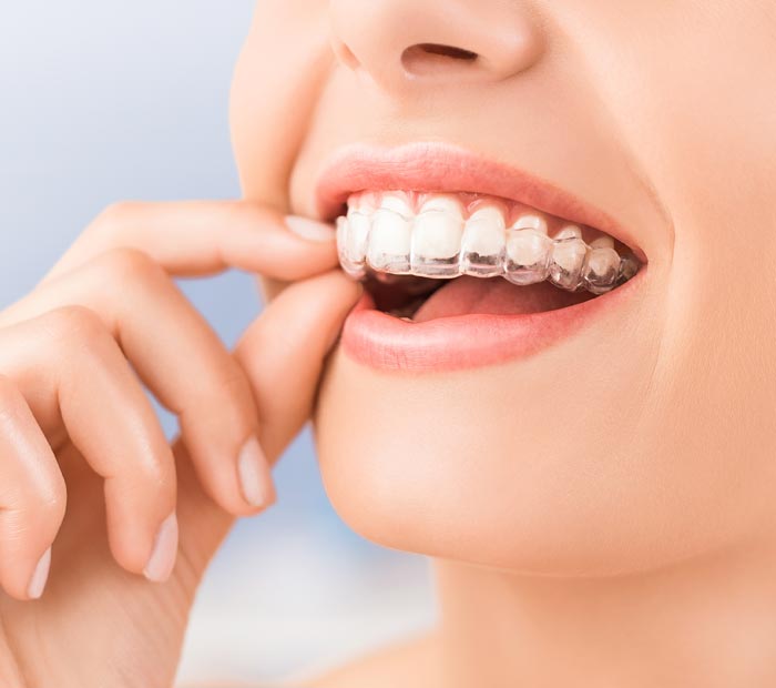 Clear Retainer